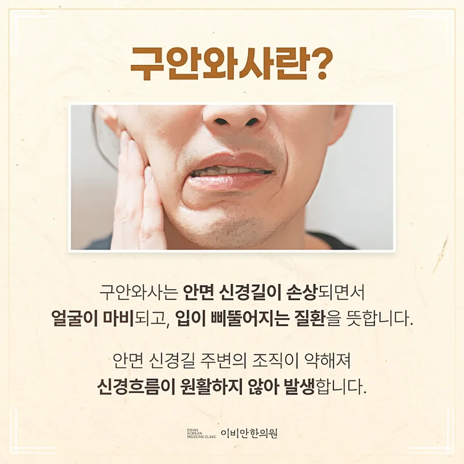 안면마비 재발, 이비안한의원
