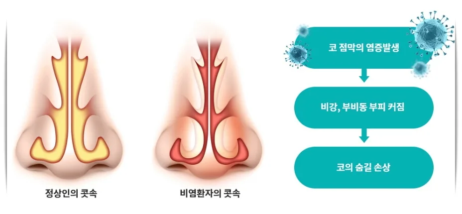 비염 축농증 차이 설명 이미지