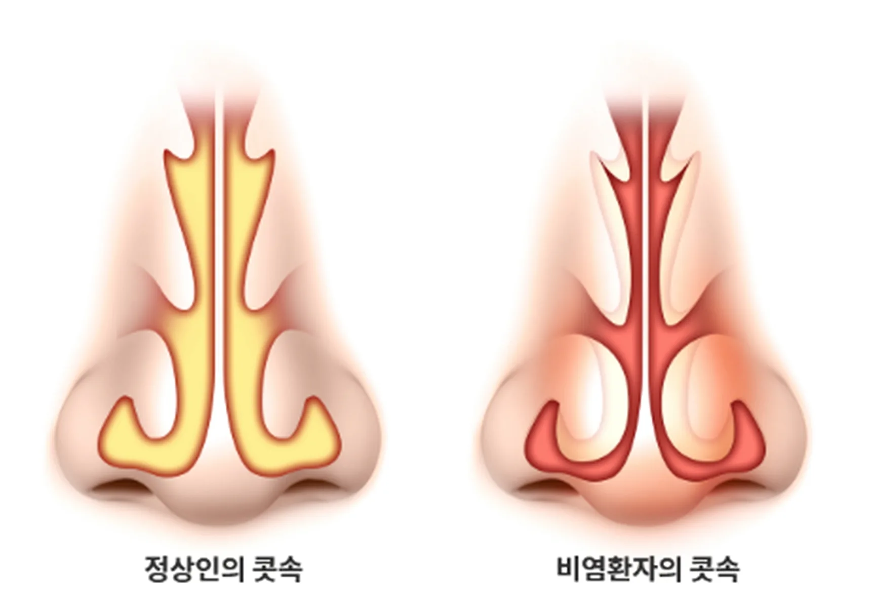 코막힘 원인이 되는 점막 염증과 부종