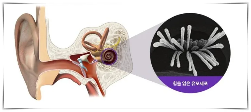 돌발성난청 귀먹먹함 설명 이미지