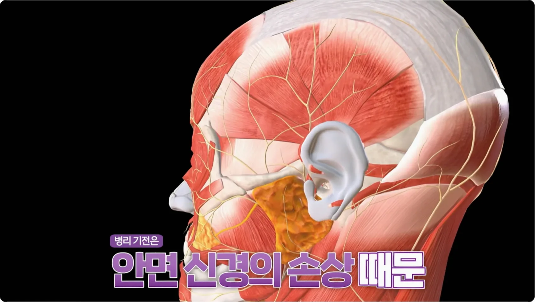 안면신경마비의 핵심 원인