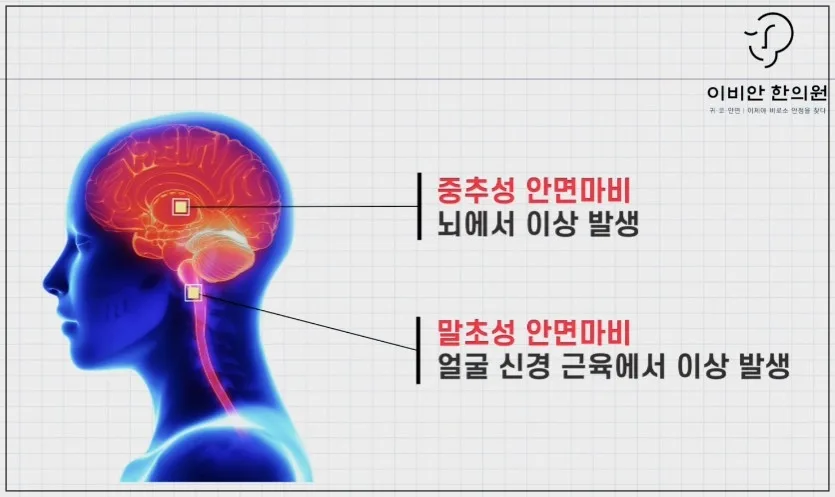안면마비 원인: 중추성과 말초성 설명 이미지